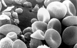 Ученые назвали пять признаков развития злокачественной анемии