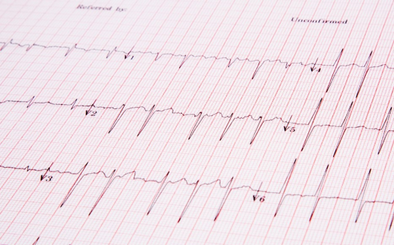 Кардиологи назвали 7 неожиданных причин сердечного приступа